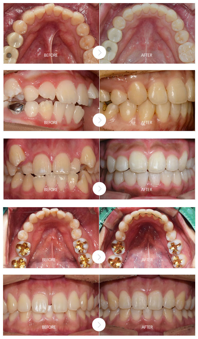 치아교정 전후사진