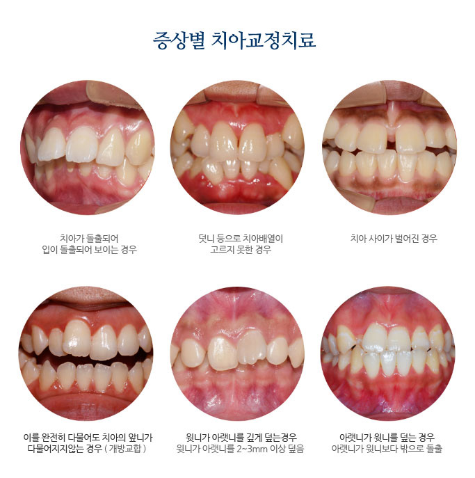 재수술 임플란트 장치별 교정종류