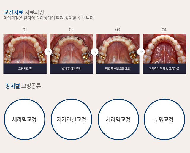 디지털 교정장치