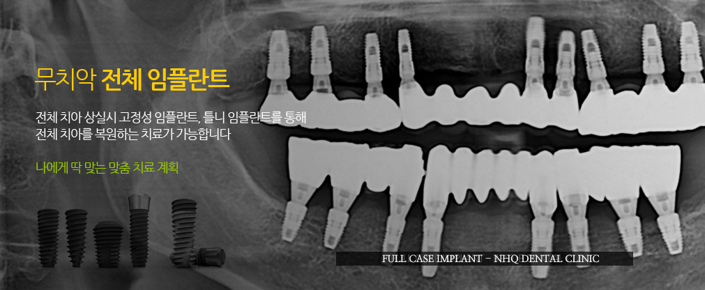 전체(무치악) 임플란트